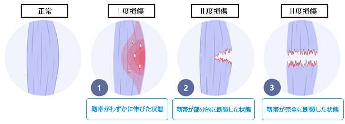 損傷靭帯の重症度評価