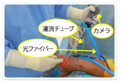 関節内部に関節鏡を挿入