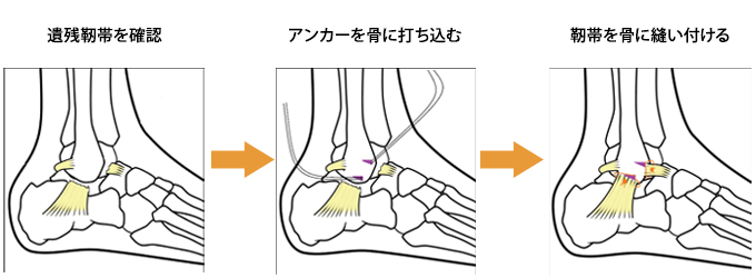 足関節鏡手術 (1)靭帯修復術