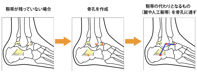 足関節鏡手術 (2)靭帯再建術