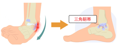 外反捻挫に伴う三角靭帯損傷