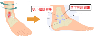 足関節底屈位での内反捻挫に伴う遠位脛腓靭帯損傷