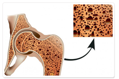 骨粗鬆症について