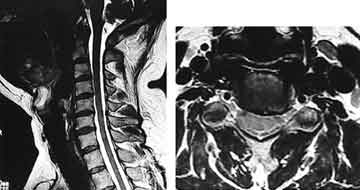 頸椎MRI撮影